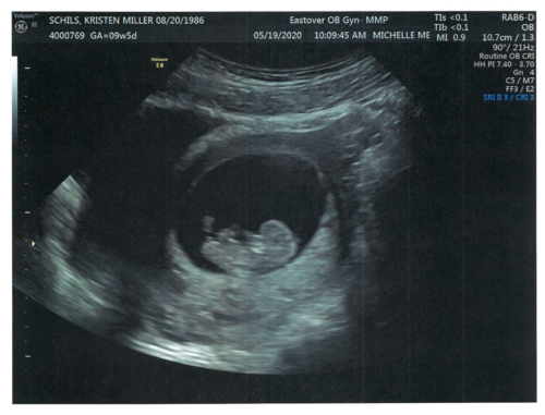 Kristen & John Baby Schils Sonogram 2020 Trimester 1 Visit 1