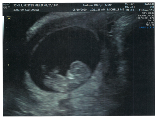 Kristen & John Baby Schils Sonogram 2020 Trimester 1 Visit 1