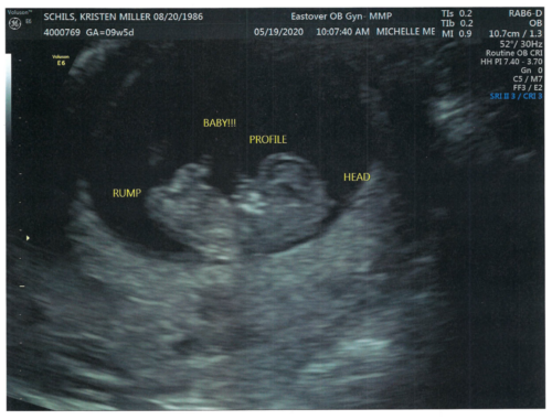 Kristen & John Baby Schils Sonogram 2020 Trimester 1 Visit 1