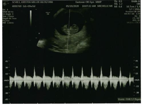 Kristen & John Baby Schils Sonogram 2020 Trimester 1 Visit 1