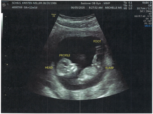 Kristen & John Baby Schils Sonogram 2020 Trimester 1 Visit 2