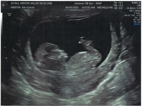 Kristen & John Baby Schils Sonogram 2020 Trimester 1 Visit 2