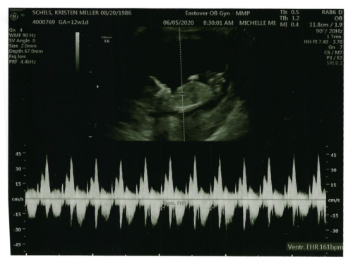 Kristen & John Baby Schils Sonogram 2020 Trimester 1 Visit 2