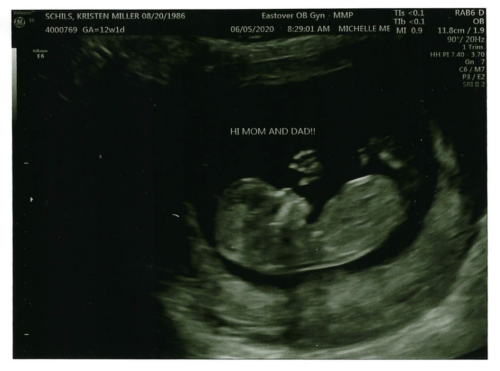 Kristen & John Baby Schils Sonogram 2020 Trimester 1 Visit 2