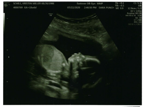 Kristen & John Baby Schils 2020 Sonograms Tri 2 Visit 3