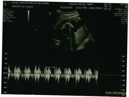 Kristen & John Baby Schils 2020 Sonograms Tri 2 Visit 3